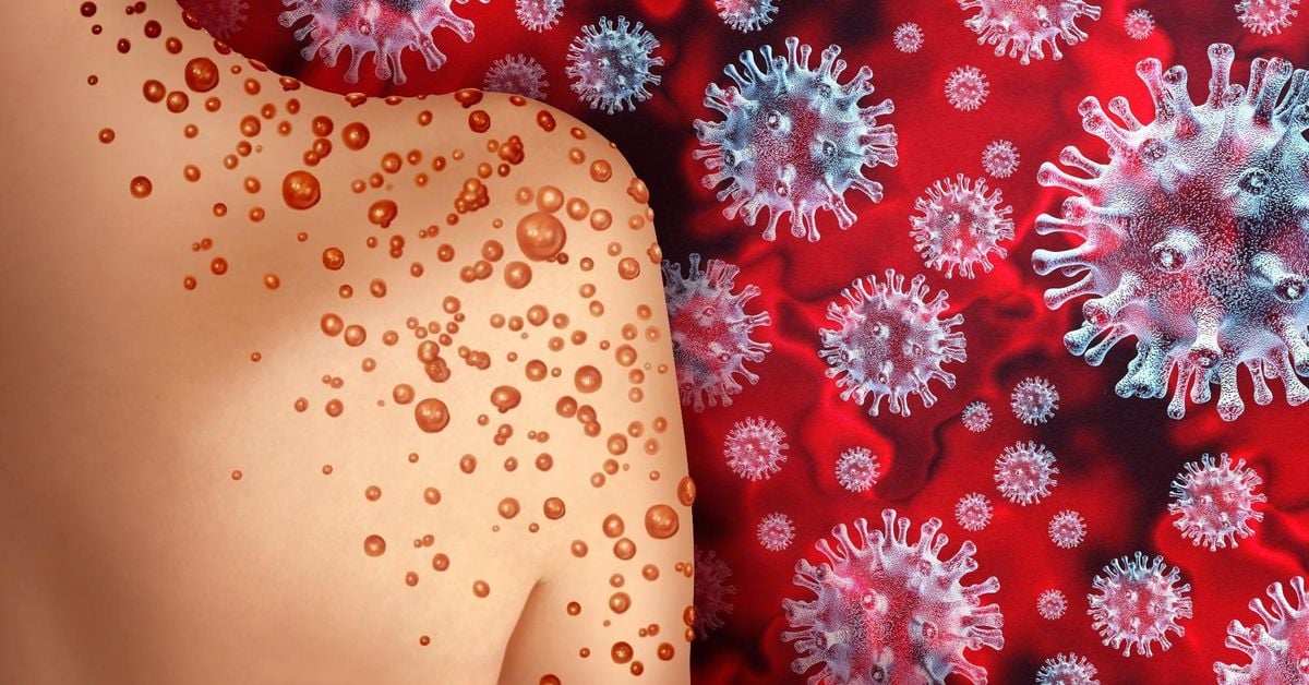 मंकीपॉक्स वायरस (monkeypox virus) : भारत में एक नई चुनौती